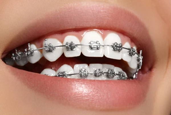 Best Orthodontic Treatment